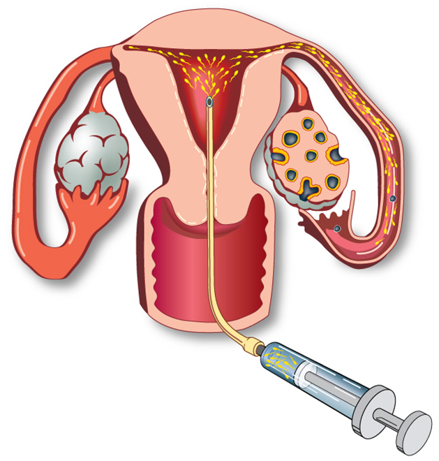 Intra-Uterine Insemination