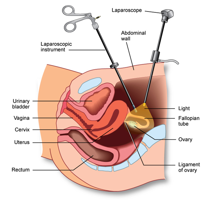 Fertility Investigations-Laparoscopy